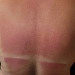 Sunburn & Windburn Relief Wipes (Travel Size) view 1