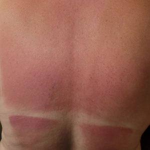 Sunburn & Windburn Relief Wipes (Travel Size)