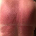 Sunburn & Windburn Relief Wipes (Travel Size) view 2